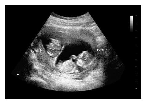 accuracy of dating scan at 12 weeks